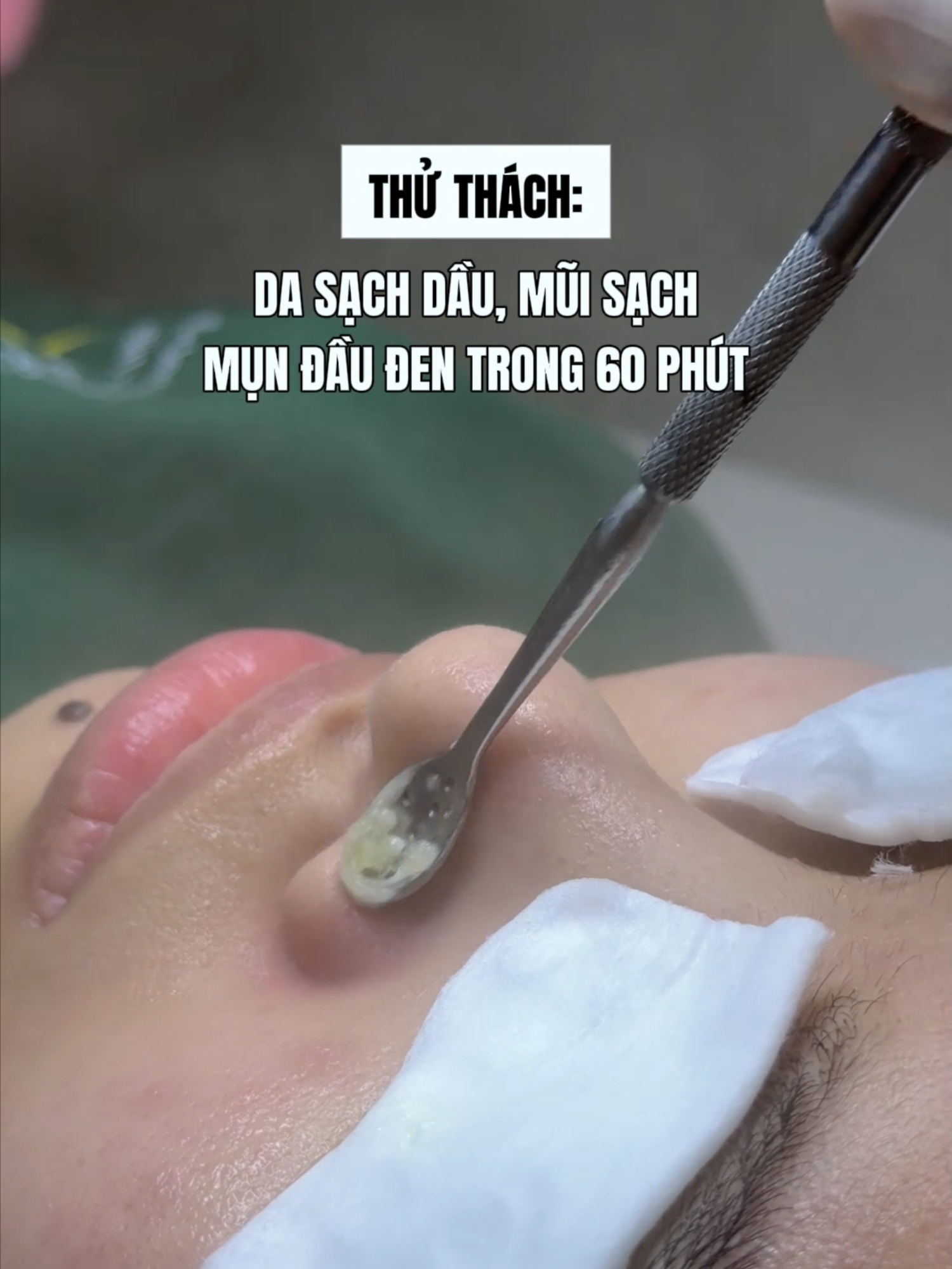 Deep Clean xong ta nói cái mũi láng o, da sạch bong dầu nhờn luôn !! #mialalanhatrang #spanhatrang #deepclean #lamsachsau #xh