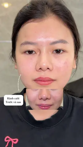 2 vùng quan trọng trên tầng mặt giữa của mình, thay đổi trũng mắt và rãnh cười bạn trẻ hơn đó nha #ThưThưBeauty #tiêmfillerphanthiết #tiêmrãnhcuời #trũngmắt #trịthâmmắt 