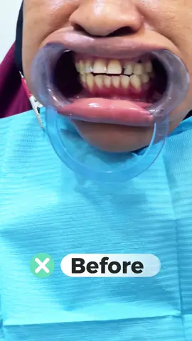 📍Decay 😱 “Hit The like button “ ❤️🤩🩺 #dentist #ilkaha #somalidentist #muqdisho #viral  