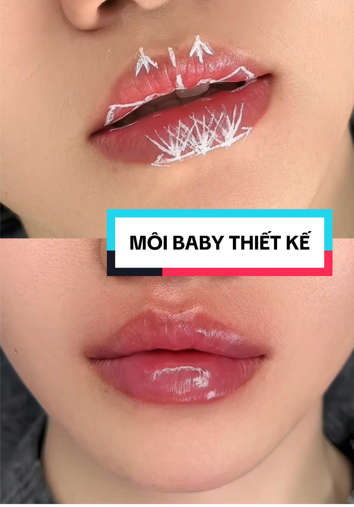 #xuhuong Biến đôi môi gồ ghề thành đôi môi mịn mướt, siêu xinh nhờ kỹ thuật độc quyền SLAY LIPS chỉ có tại HONG ANH LUMI #honganhfiller #Lumiacademy #daotaochuyennghiep #fillerbotox 