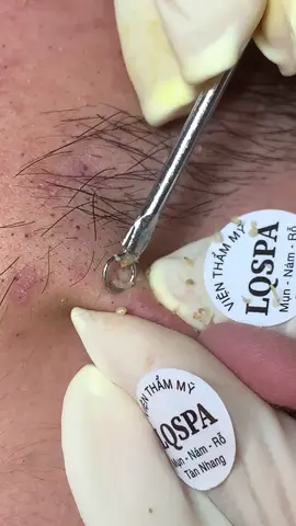 Hơi nhói #chamsocdamun#chamsocdaseo#chamsocdanam#tanbinh#Lqspa&academy