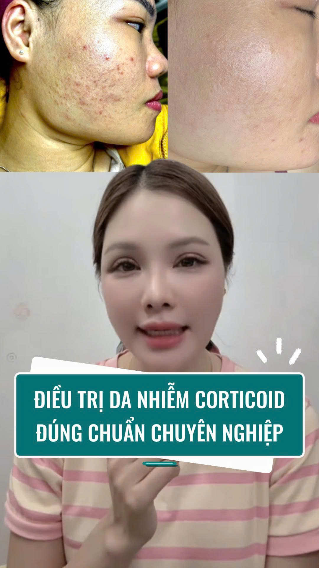 - Mình đã điều trị ca mụn nhiễm CORTICOID này như thế nào ???#duocmyphamchauaucaocap #daotaohocvienchuyennghiep #dieutrilochanlongto #GOLDSPA #biorepeeltca 