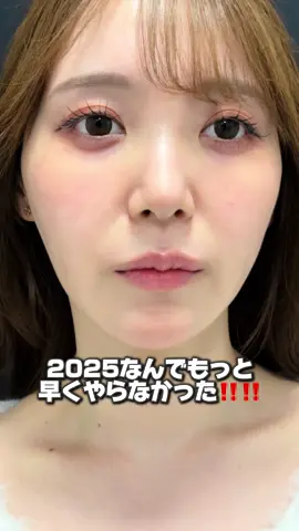 【2025なんでもっと早くやらなかった‼️ ほうれい線＆貴族ヒアルの施術レポ💖】 ①まずはカウンセリング ➡️緊張すると思いますが、自分のなりたい✨️を先生にきちんと伝える！！！！ そうすることで自分のなりたい＆理想と少しでも近づく提案を先生がしてくれます☺️ ②施術準備 ➡️痛みに弱い方、怖い方は笑気麻酔＆ブロック麻酔を使用できます！ 笑気麻酔は酔っ払った感じになって、ブロック麻酔は歯医者さんの麻酔みたいに口元の感覚が無くなってきます！ ⬆️これは2-3時間で無くなります✨️ ③施術開始 針を刺す時の一瞬のチク！だけが痛い😭😭 その後の痛みは全くありません🥹💖  先生と鏡を見ながら、起き上がったりしてみて適宜注入量をチェックしていきます✨️ なんかやっぱり足りないかも、ここにもう少し入れて欲しい、、ということも伝えることが大事💮💯 ⬆️私はいつも細すぎて先生方に大迷惑をかけております😃😃😃🙇‍♀️🙇‍♀️💦 ④施術終了 終了後は直ぐにメイクして🆗💡 施術直後〜1週間は腫れが少しあって口元の違和感があった3週間たってめちゃくちゃ馴染んだ😫💖 ⬆️これは個人差があり！！！内出血が出る方もいます😭😭💦 ほうれい線の治療にも適応不適応や、ヒアルロン酸で治るケースや脂肪が原因のケースもあるので、まずは医師のカウンセリングが大事です☝️💫 なにか質問があればコメントやインスタにDMお待ちしております✨️🎶 ほうれい線気になる方はぜひチェックしてみてねっ૮(˶ᵔ ᵕ ᵔ˶)ა       ##ほうれい線#垢抜け#ヒアルロン酸##ほうれい線改善##貴族フィラー