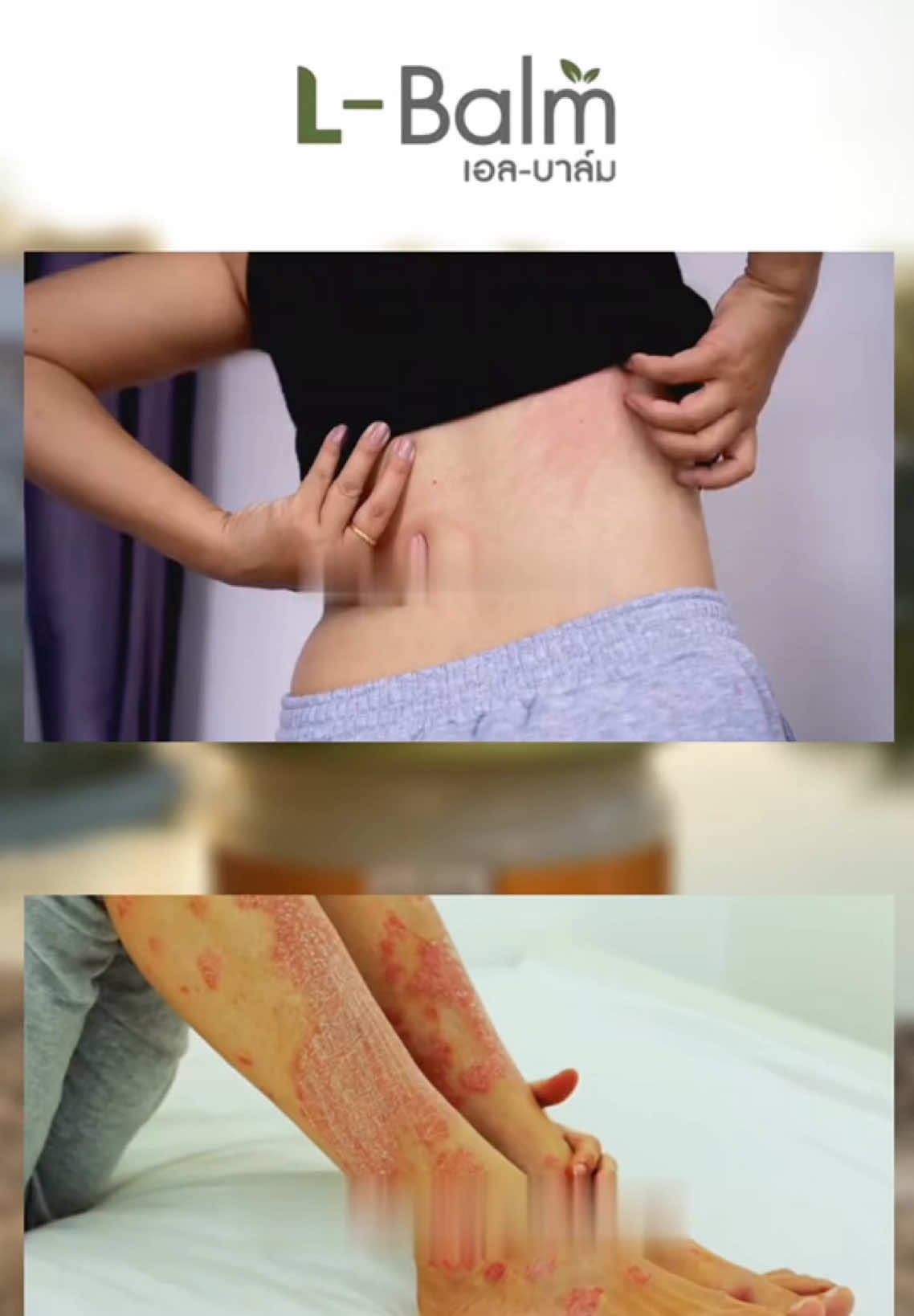 #lbalmศุภะ #น้ำเหลืองเสีย #สะเก็ดเงิน #ศุภะสมุนไพร 