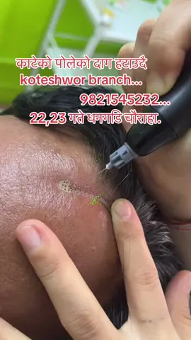 #scar #daag #pigmentation #acnetreatment #fyppppppppppppppppppppppp 