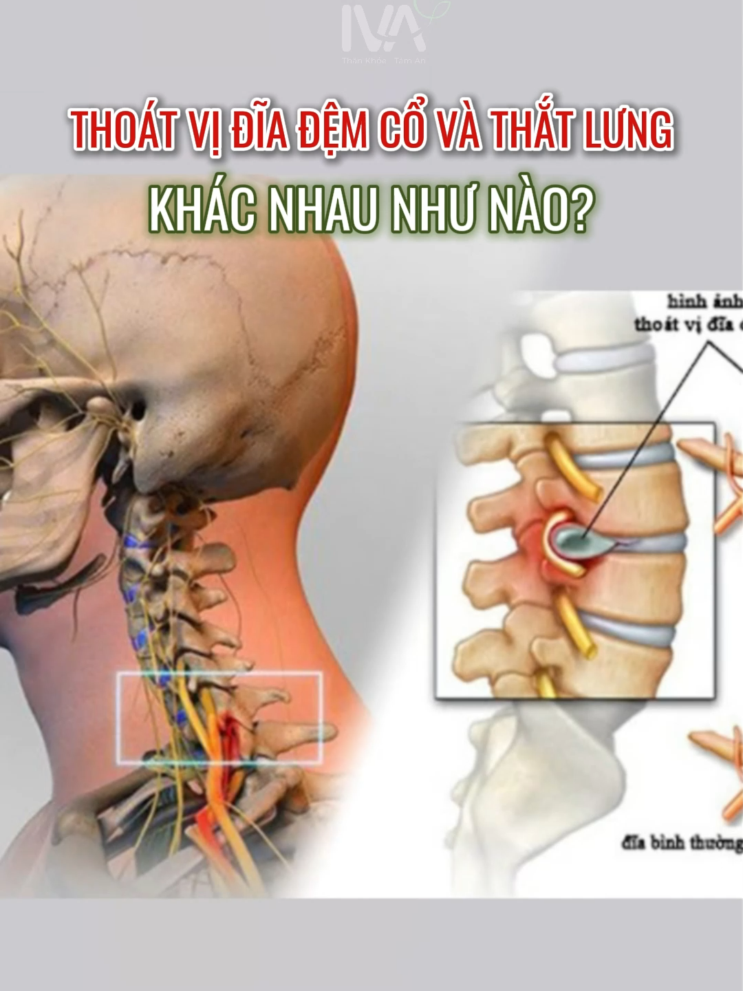 Thoát vị đĩa đệm cổ và thắt lưng khác nhau như nào? #Ivatrilieu #ivatrilieuq7 #trilieucovaigayq7 #trilieuchuyensau  #thoatvidiadem