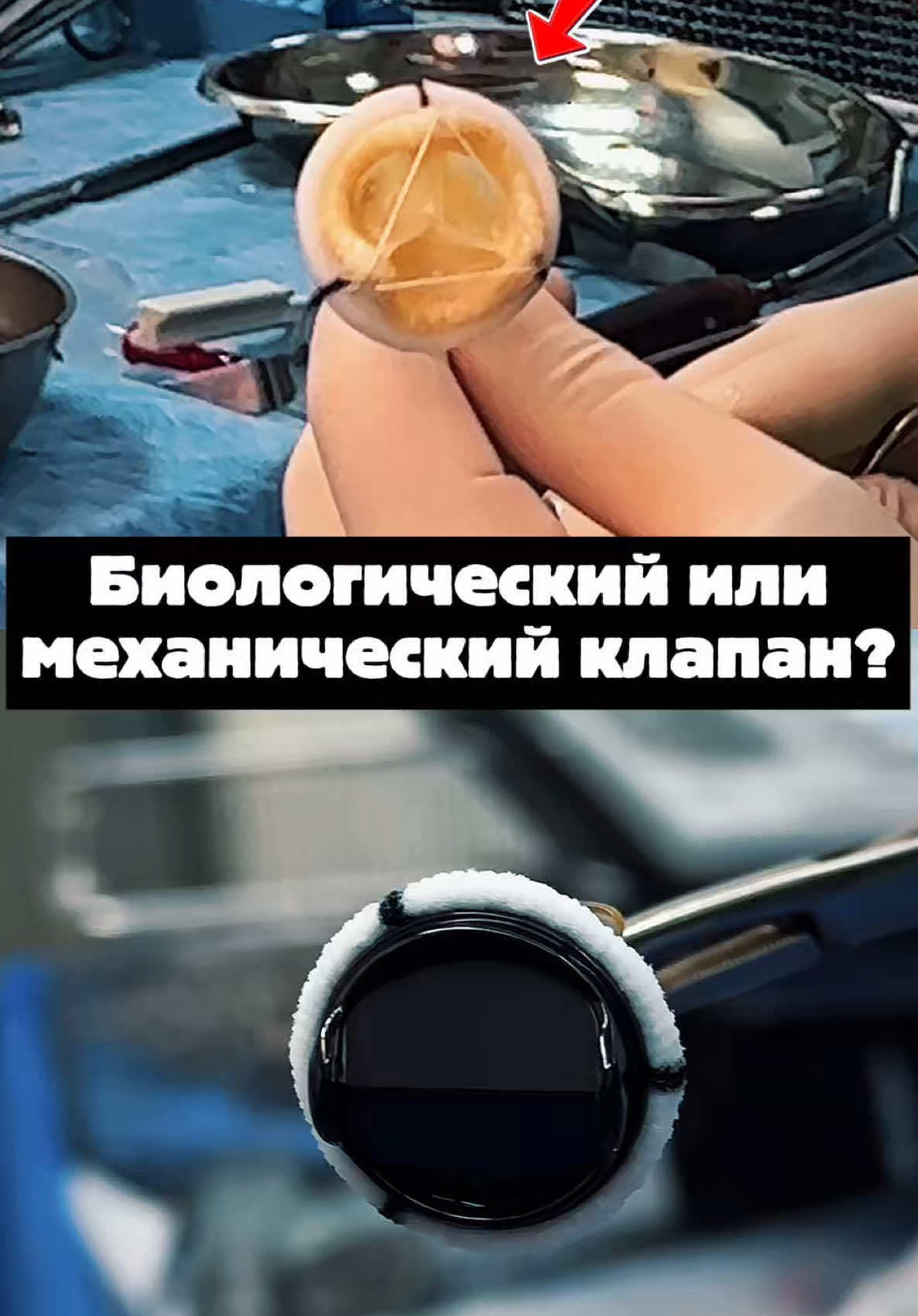 Механический или биологический клапан? #медицина #студентмедик #кардиохирургия #кардиохирург @КАРДИОХИРУРГ @Кардиохирург 