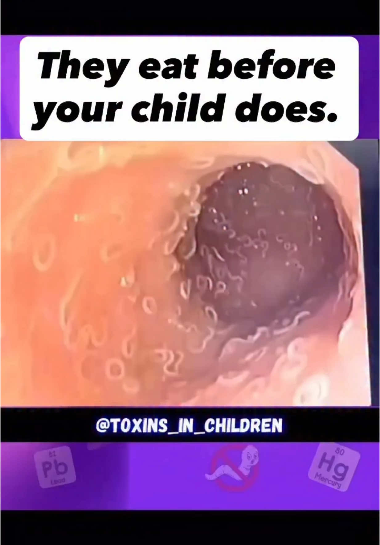 FULL BODY PARASITE CLEANSE 🧠🐛 Here’s what no one tells you: parasites don’t sit politely in the gut. They burrow, migrate, lay eggs, form biofilms, and protect themselves. If you’re only “cleansing your gut,” you’re not killing them you’re giving them a ticket to relocate. A real cleanse makes your whole body uninhabitable to them. Yes your liver, lungs, skin, lymph, brain and beyond. I don’t do one-and-done “detox teas.” I follow a strategic protocol that works on every level. I start with herbal tinctures used for centuries worldwide. These target worms, flukes, protozoa every stage of their life cycle. They work deep, not just in the intestines. But here’s the part that changed everything for me: Parasites don’t just live in you. They feed on heavy metals and thrive in toxic environments. And when they die? They dump that load straight into your bloodstream. That’s why people get headaches, rashes, fatigue, mood swings, brain fog and call it “normal die-off.” It’s not normal. It’s metals being released with nothing to bind them. So I always pair my cleanse with a heavy-metal detox using cellular-level zeolite, The micronized zeolite I use is small enough to go beyond the gut and bind metals hiding in tissues, organs, and yes even the brain. When the metals are gone, parasites lose their shield. Your body becomes a place they can’t survive, not just a temporary eviction notice. Skip this step? They hide, regroup… and come back stronger. Stop treating symptoms and start treating their environment. This is how I made my body a place they can’t call home: Cleanse the whole body. Bind and remove metals. Stop playing host. This isn’t a trend. It’s biology and if you’ve been battling “mystery symptoms,” poor sleep, skin flares, sugar cravings, or brain fog… it’s time to look deeper. If you want the exact full-body protocol we use at home, comment DEWORM below and I’ll send it to you.