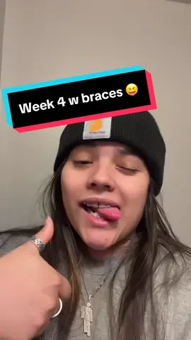 It’s still so crazy that I have a piece of metal screwed into my upper jaw😭🤣 this is turn # 3 after braces #marpe #marpeexpander #braces #palateexpander 