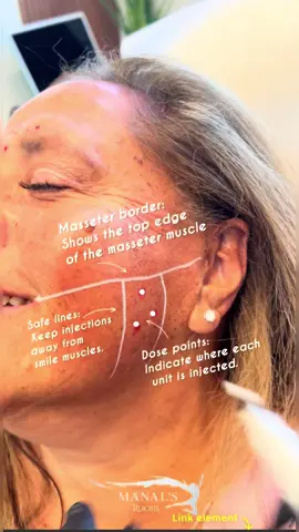 Masseter Botox helps with jaw tension and also facial slimming. #masseterbotox #botox #aesthetic #medspa #facebymanal