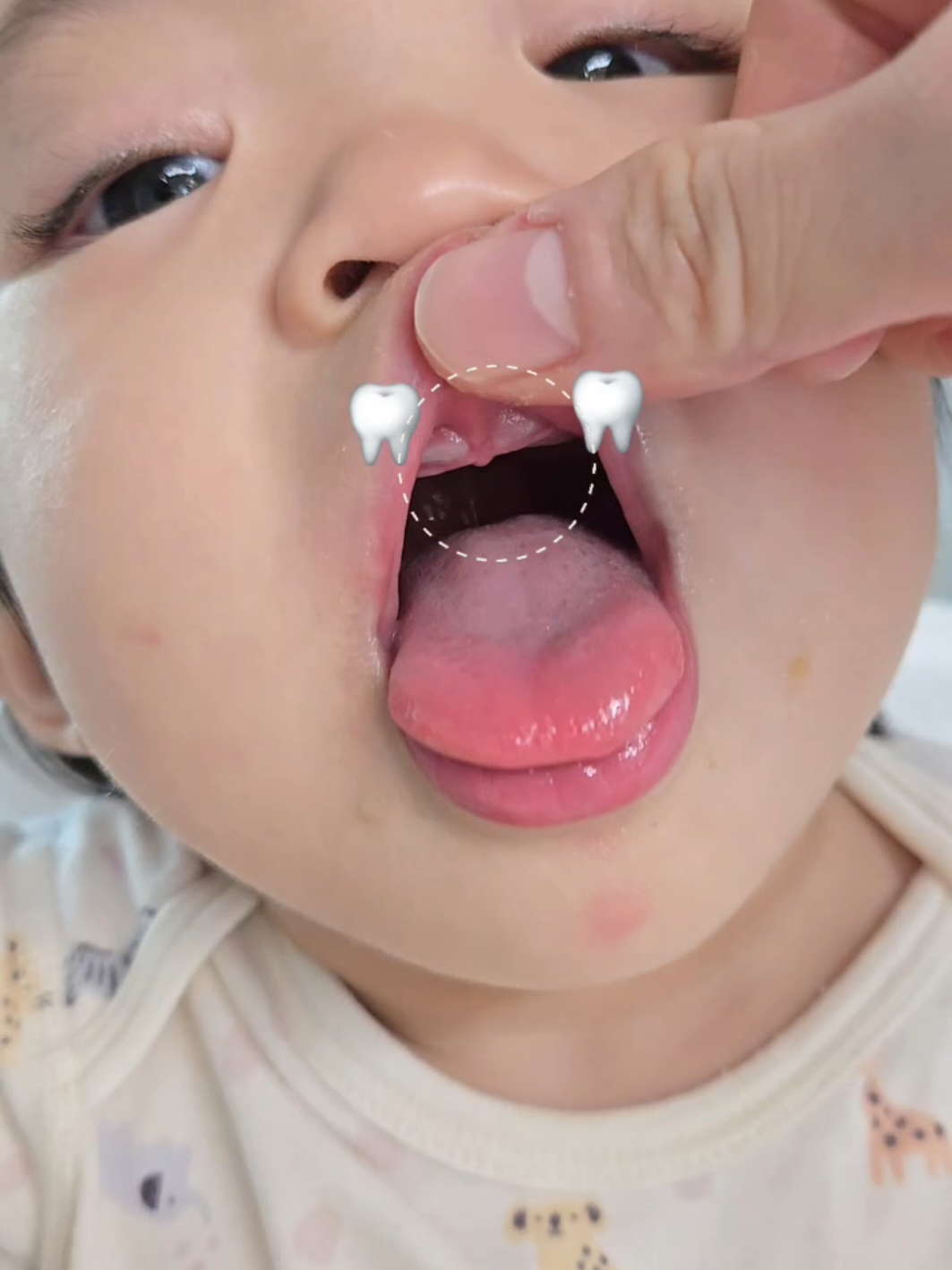 이 3개가 동시에 나오다니!!!!! #14개월아기 #이앓이 #육아일상 