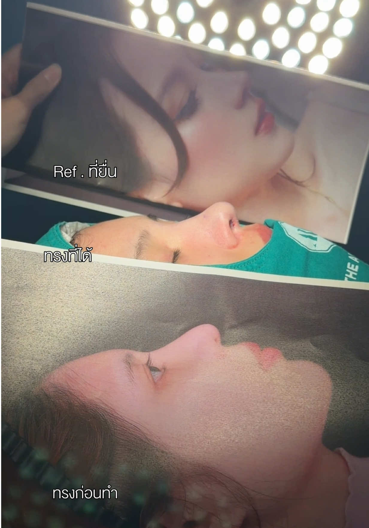 Ref.ที่ยื่น  กับทรงที่ได้ 😍 อยากได้ทรงจมูกแบบคุณ #ใบเฟิร์นพิมพ์ชนก  #theartclinic #เสริมจมูกดิอาท #ทรงจมูกยอดฮิต #จมูกเซมิโอเพ่น 