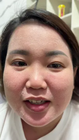 Độ quả da ăn tết . Giảm Nám tàn nhang rõ rệt luôn #Nám  #tannhang  #laohoa  #peelda  #skincare 