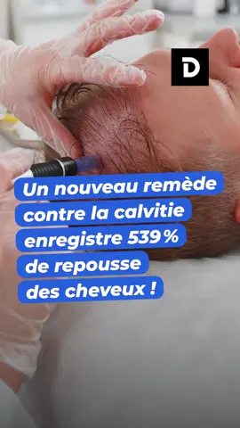 Un nouveau remède contre la calvitie enregistre 539 % de repousse des cheveux ! #cheveux #calvitie #solution 