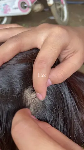 😱😱#omg #lice #liceremoval 