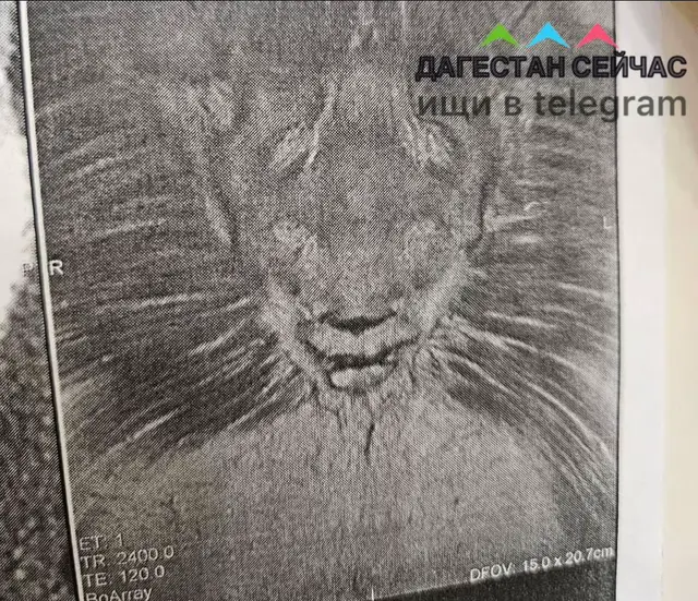 Шайтан (джин) в образе льва обнаружен во время снимка МРТ у пациента В Дагестане исламский целитель долгое время лечил человека, у которого были ночные кошмары, тревоги, сонливость и плохое самочувствие. Выяснилось, что у него между лопаткой и позвоночником нечто похоже на голову льва. По словам целителя, именно в этой зоне формируют узлы сихры (проклятия).  #islamic #ислам #джин #сглаз #зависть 