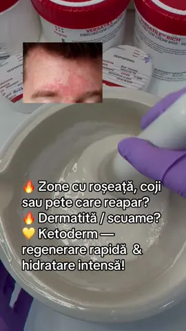 💛Ketoderm Cremă Apothek este formulată pentru perioadele în care pielea dezvoltă roșeață, coji, iritații sau zone sensibile care apar recurent, mai ales în pliuri, pe trunchi, gât, axilă, zona inghinală sau pe picioare. Formula intensivă ajută la: ✔ reducerea disconfortului local ✔ uniformizarea aspectului pielii ✔ calmarea zonelor iritate ✔ exfoliere delicată pentru pielea cu coji ✔ refacerea barierei cutanate Ideal pentru persoane care se confruntă cu: • pete care se extind / reapărute periodic • zone care „se cojesc” • roșeață + mâncărime • piele sensibilă în pliuri • dermatită/ scuame  Ketoderm — îngrijire profesională pentru pielea iritată  💛 Detalii complete + modul de folosire → Apothek #skincare #piele #coji #pete #ketoderm 